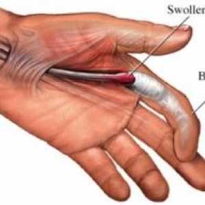Trigger пръст: причини, лечение, симптоми, признаци, превенция