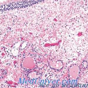 Сифилис щитовидната морфология, патоанатомия