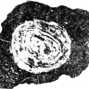 Слюнка камък sialolithiasis заболяване