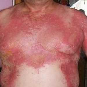 Стафилококов синдром на изгорена кожа: лечение, причинява, Симптоми, признаци