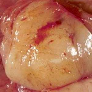 Стомаха гастроинтестинален стромален тумор (GIST, ист)