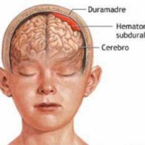 Субдурален хематом мозъка: последици за третиране
