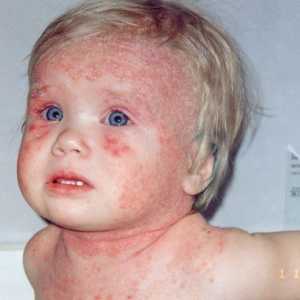 Обрив при дете при дисбактериоза