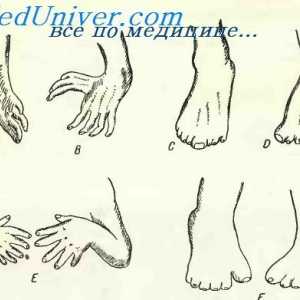 Тератология. Нарушенията на ръцете и краката на ембриона