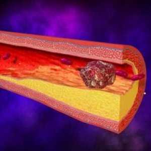Тромбоза на артериите на горните крайници