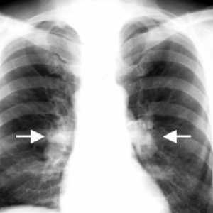 Туберкулоза на интраторакални лимфни възли: лечение, усложнения, причините, симптомите
