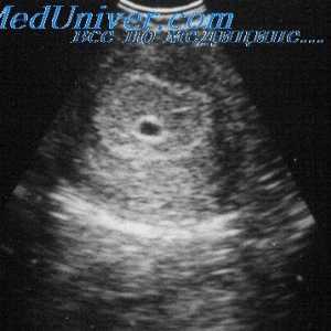 Ултразвук в първия триместър на бременността. Показания за трансвагинална ехография в първия…