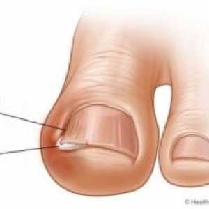Врастнали нокти на краката си: лечение, причини, симптоми, признаци