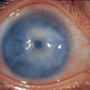 Средно глаукома око: лечение, причини, класификация, симптоми, признаци