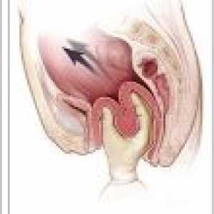 Маточната шийка обръщане по време на раждане: лечение, причини, симптоми, ефекти