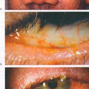Заболявания на конюнктивата очна розацея