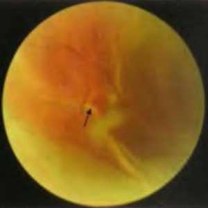 Заболявания на периферията на ретината: регматогенно отлепване на ретината. Епидемиология и…