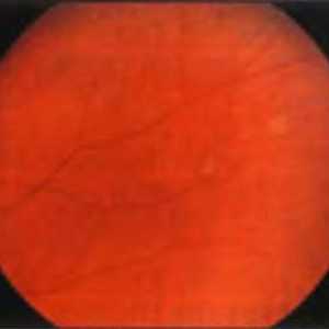 Заболявания на периферията на ретината: витреоретинална лъч и се сгъват меридионален