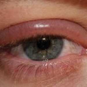 Заболявания на век човешкото око: лекуване, профилактика и Признаците, симптомите причини